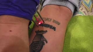 Tattoo Removal 1st Treatment with Cutera Enlighten [upl. by Donelson393]