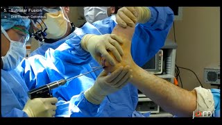 Subtalar Arthrodesis for PostTraumatic Subtalar Arthritis Links to Full Procedure [upl. by Adaynek410]