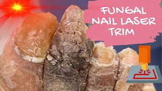 Toe Nail Fungus Cured With No Meds [upl. by Ttelracs235]