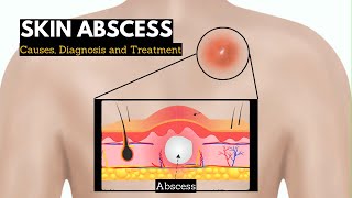 Skin Abscess Causes Signs and Symptoms Diagnosis and Treatment [upl. by Aihsikal]