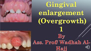 17Periodontal diseases 7 Gingival enlargement1Dr Wadhah Periodontology lectures د وضاح الحاج [upl. by Alvis957]