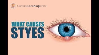 What Are Styes Causes Symptoms and Treatments [upl. by Jenilee]