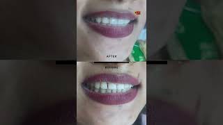 Teeth Gap Treatment shorts dranbudentist [upl. by Sibelle]