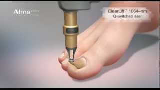 ClearChoice Latest Nail Restoration Technology Nail Fungus Treatment [upl. by Leunad]