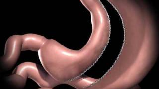 Gastric Sleeve Procedure [upl. by Fregger]