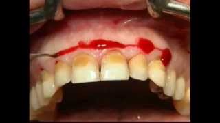 Gingival Surgery  External Bevel [upl. by Atrahc]