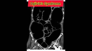 Ogilvies Syndromemedicalshorts medicalvideos medicalstudent medicalschoolmedicalschoolvlog [upl. by Pease]