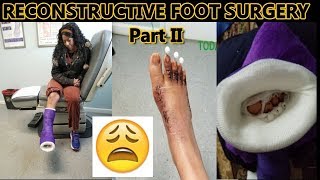 Part 2 The BUNION Surgery Process  My Bunion Surgery Experience on Surgery Day [upl. by Naiva]