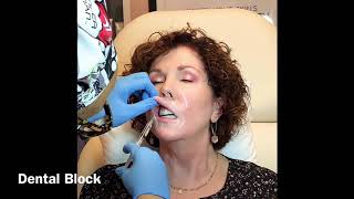 Lip Filler using Dental Block and Flexible Cannula Technique yourbestyoumedicalspa [upl. by Anairda]