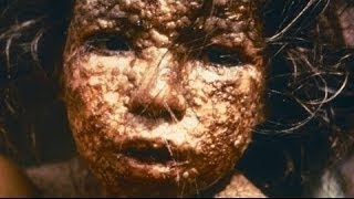 The Deadly Smallpox Virus Documentary History Channel [upl. by Enitsirt82]