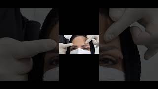 blepharoplasty gone wrong [upl. by Broek]