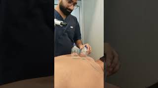 Cupping therapy for back pain after cervical canal stenosis operation bestphysiotherapy [upl. by Pen37]