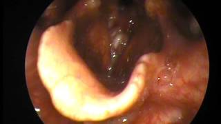 Glottic Carcinoma pre and after Direct Laryngoscopy [upl. by Ihel]