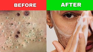 Best Face Wash For Fungal Acne  My Secret Revealed [upl. by Ajet]