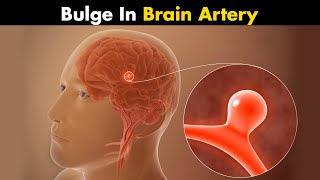 Cerebral Aneurysm  What Causes Bulge in Brain Artery UrduHindi [upl. by Valorie809]