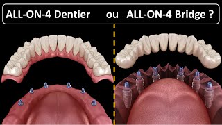 All on 4  Type de prothèse  Dentier ou Bridge [upl. by Anuaf]