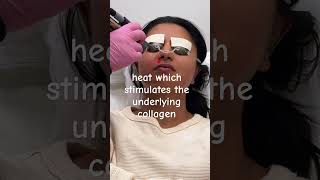 Collagen Production with Instant Glow Laser Facial ✨ laserfacial collagen laseraway [upl. by Neel]