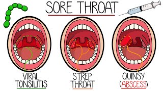 Sore Throat Explained Including Strep Throat amp Peritonsillar Abscess [upl. by Nwahsit]