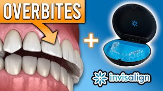 Can Invisalign FIX Overbites amp Other Bite Problems  Premier Orthodontics [upl. by Alaecim]