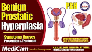 Benign Prostatic Hyperplasia Symptoms Causes And Treatment [upl. by Yrrap]