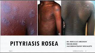 pityriasis rosea by dr abraham dermatology educational lecture [upl. by Ailsun]