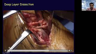 Posterolateral Approach to the Ankle [upl. by Drauode]