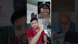 Amazing Hair Transformation hairtransformtion hairtransplant [upl. by Lhary]