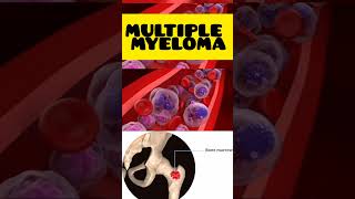 Multiple myeloma multiplemyeloma malayalam cancer hypercalcaemia high calcium genetics [upl. by Lombard]