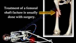 Fracture of the Femur and its fixation  Everything You Need To Know  Dr Nabil Ebraheim [upl. by Theodoric]