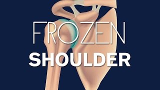 What is a frozen shoulder [upl. by Knorring]