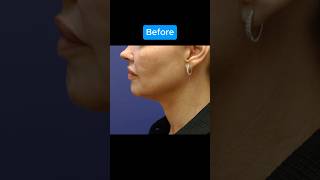 HUGE FACELIFT TRANSFORMATION [upl. by Ylrebmi]