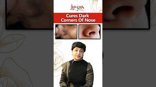 Cure Dark Corners of Nose nose whiteheads blackheads melanin corners pigmentation shorts [upl. by Lipski241]