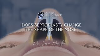 Does a septoplasty change the shape of the nose [upl. by Araihc]