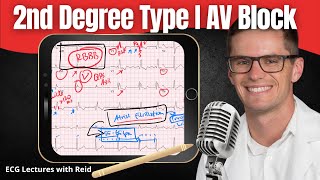 Second Degree Type I AV Block EKG  ECG Lecture [upl. by Euseibbob915]