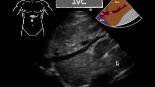 POCUS Cardiac IVC Respiratory variation [upl. by Richey]