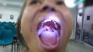 Orticochea Palatoplasty Cleft Palate Secondary Surgery 2 [upl. by Weismann]