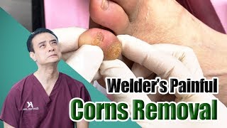 Welder’s Painful Corns amp Calluses Removal [upl. by Anniahs]