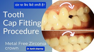 Tooth capping procedure  Cap कैसे फिक्स होती है Zirconia cap  Tooth Cap Fitting [upl. by Thursby]