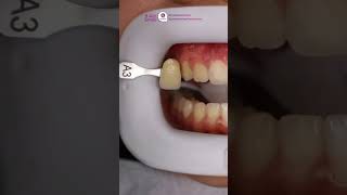 Ingin memutihkan gigi agar semakin percaya diri Dental Spa solusinya fypシ dentist asmrdentist [upl. by Oicnaneb]