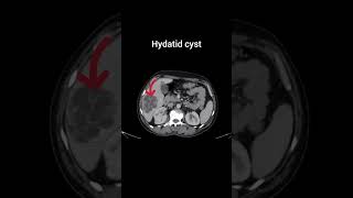 Hydatid cystkista hidatid xray radiology kista [upl. by Ahsote]