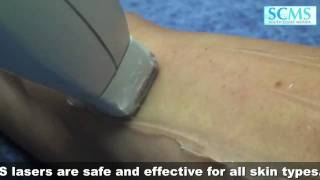 Laser Hair Removal Side Effects [upl. by Laamak]