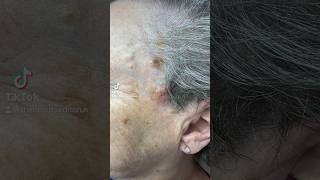 Amazing Skin Transformation Wart removal… RESULTS 🤩 [upl. by Mackay]