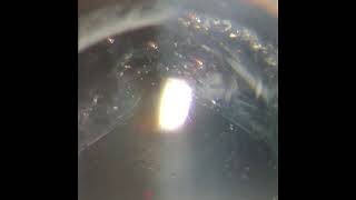 Capsulotomia Yag Laser [upl. by Philander]