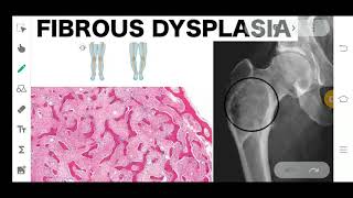 FIBROUS DYSPLASIA  ORAL PATHOLOGY  BONY DEFECT [upl. by Atinhoj]