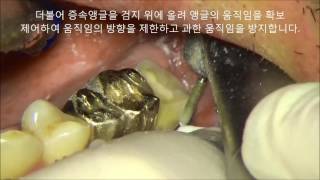 Mx 2nd molar prep in hard condition under microscopeKorean ver [upl. by Liahkim50]