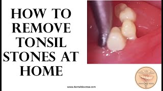 How to remove tonsil stones at home  Tonsil stone removal [upl. by Dennett936]