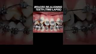 Time lapse of braces realigning crooked teeth dentist tooth medical health [upl. by Limbert]