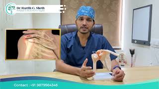 Rotator Cuff Tear Shoulder Pain Treatment Partial Shoulder Surgery in Pal Vesu Athwagate Surat [upl. by Porty]