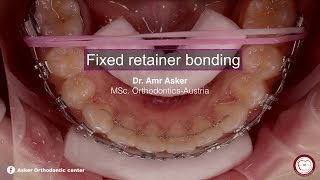 fixed permanent retainer bonding in orthodontics by dr Amr asker [upl. by Nellahs567]