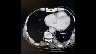 Adenocarcinoma of left lung with extrathoracic and intraspinal extension [upl. by Inahpit]